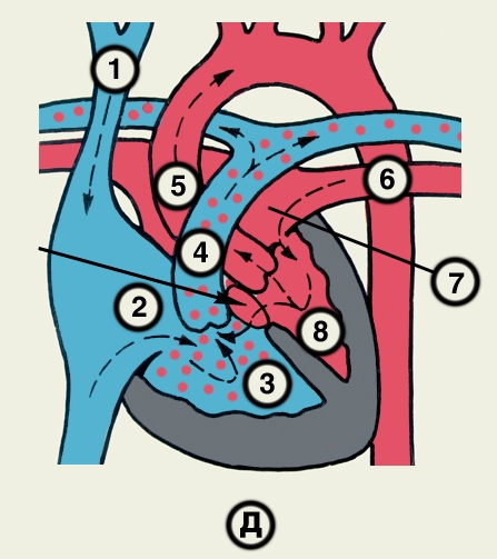 Рис. 23д). Схематическое изображение отдельных врожденных пороков сердца (направления кровотока обозначены пунктирными стрелками, локализация пороков — сплошными стрелками): дефект межжелудочковой перегородки; 1 — верхняя полая вена, 2 — правое предсердие, 3 — правый желудочек, 4 — легочный ствол, 5 — аорта, 6 — легочная вена, 7 — левое предсердие, 8 — левый желудочек