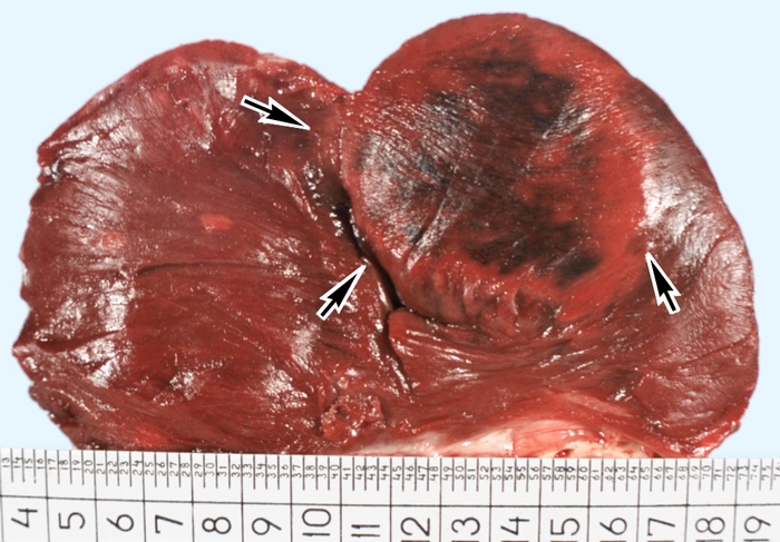 Рис. 2. Макропрепарат вскрытого сердца с геморрагическим инфарктом: на разрезе виден темно-красный очаг некроза (указан стрелками)