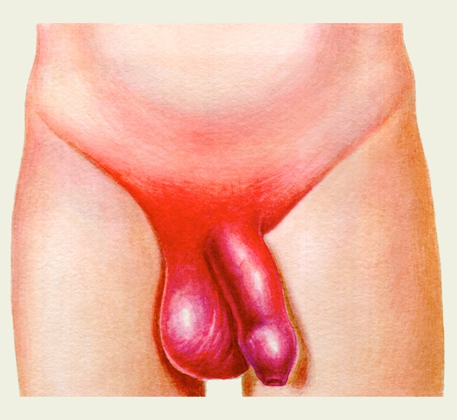 Рис. 5а). Наружные половые органы при проникающем повреждении полового члена, осложненном мочевым затеком: воспалительная <a href=
