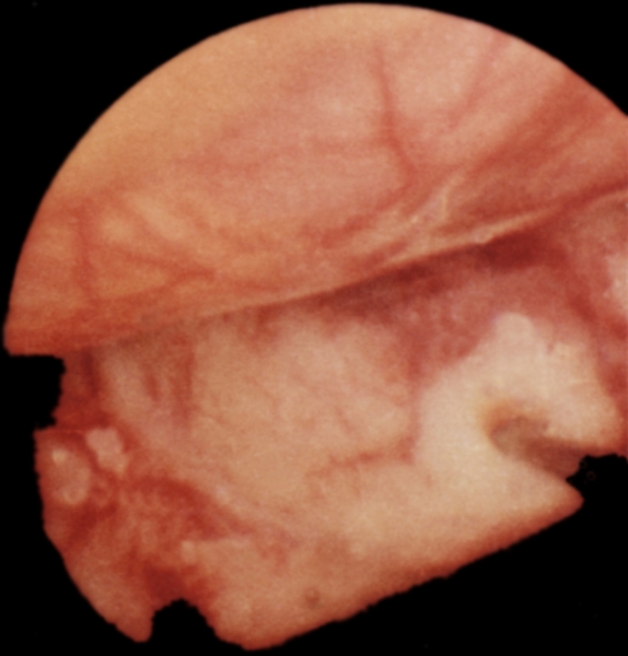 Рис. 16. Лапароскопическая картина метастазов рака желудка в левой доле печени