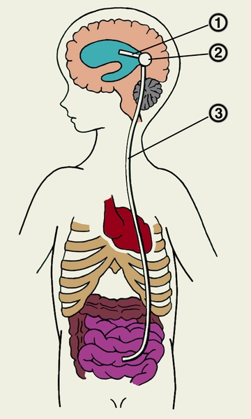 Рис. 6. Схема вентрикулоперитонеального шунтирования при гидроцефалии: 1 — катетер, введенный в боковой желудочек головного мозга; 2 — помпа; 3 — катетер, введенный в брюшную полость