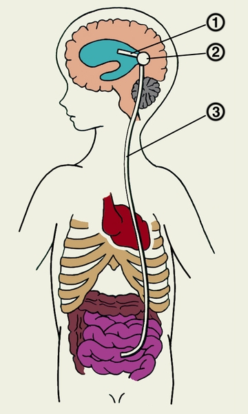 Шунт при гидроцефалии. Шунтирование желудочков мозга. Вентрикулоперитонеальный шунт схема. Шунтирование спинномозговой жидкости. Шунтирование мозга в брюшную полость.
