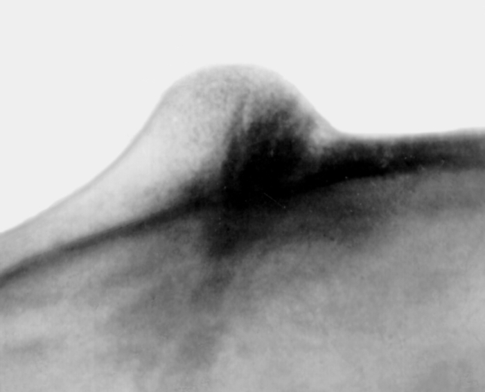 Рис. 5б). Рентгенограмма черепа больного при компактной остеоме теменно-височной области: прицельная (тангенциальная) рентгенограмма черепа, на которой видна структура компактной остеомы, расположенной в губчатом слое кости и наружной костной пластинке