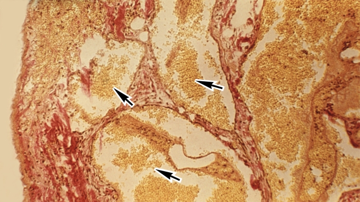 Рис. 2а). Микропрепараты париетальной и висцеральной брюшины при гнойном перитоните: резкая гиперемия вен (указаны стрелками), <a href=