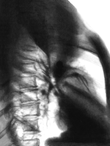 Рис. 2б). Рентгенограмма грудной клетки при ателектазе верхней доли правого легкого (правая боковая проекция): верхняя <a href=