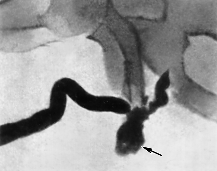 Рис. 4. Уретрограмма больного с разрывом перепончатой части мочеиспускательного канала: на разрыв указывает затек (указан стрелкой) рентгеноконтрастного вещества в окружающие ткани