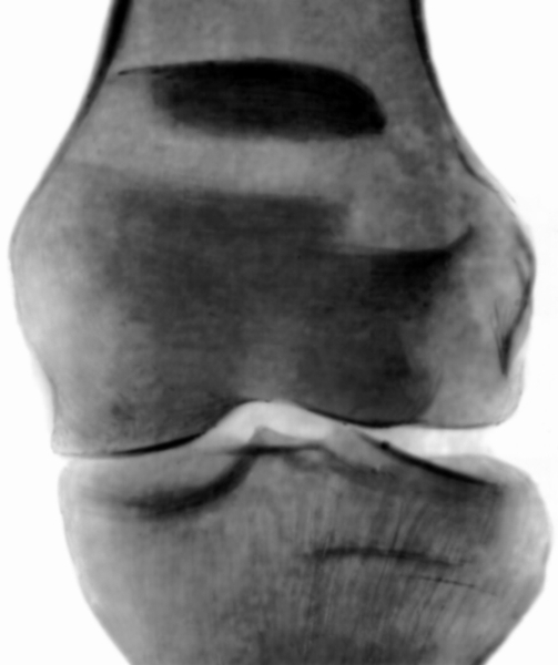 Рис. 21а). Рентгенограмма коленного сустава при поперечном переломе надколенника с расхождением отломков: прямая проекция
