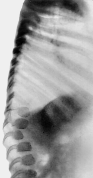Рис. 2а). Рентгенологические признаки синдрома Гурлер — изменения ребер и позвоночника