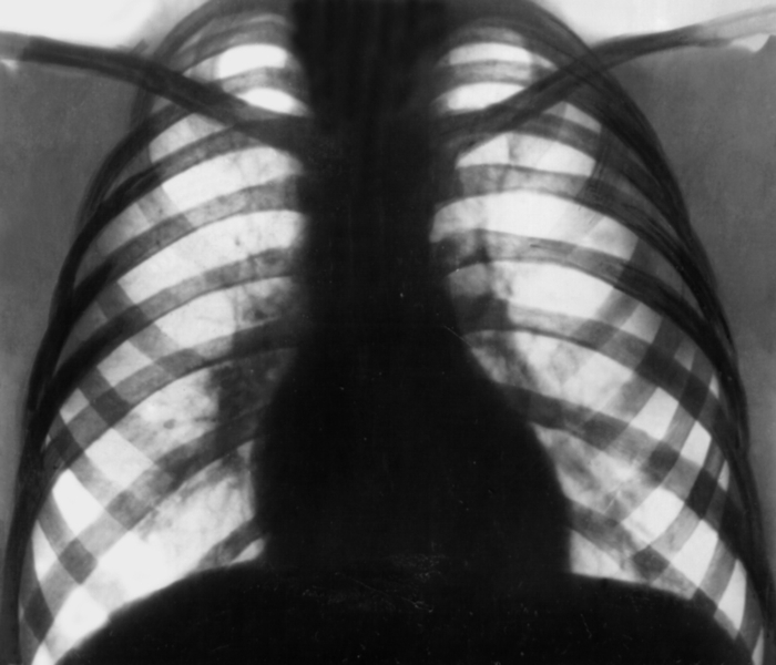 Рис. 3 а). Рентгенограмма в прямой проекции органов грудной клетки при туберкулезе внутригрудных лимфатических узлов: тень корня правого легкого расширена и уплотнена за счет увеличенных лимфатических узлов