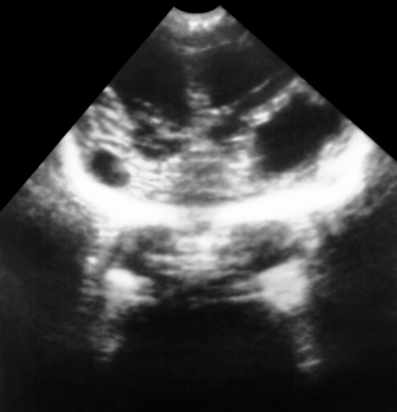 Рис. 2. Ультразвуковая картина головного мозга ребенка с множественными кистами на месте очагов кровоизлияний
