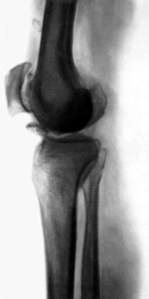 Рис. 25. Рентгенограмма коленного сустава при болезни Левена, сопровождающейся образованием внутрисуставных тел