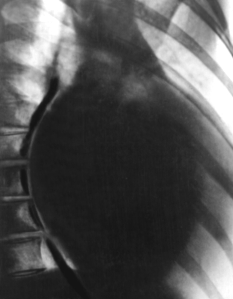Рис. 5б). Рентгенограмма грудной клетки больной с хронической митральной недостаточностью (правое косое положение): тень сердца значительно увеличена, контрастированный <a href=