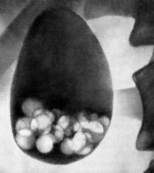 Рис. 5. Холецистограмма при желчнокаменной болезни: множественные камни в контрастированном желчном пузыре