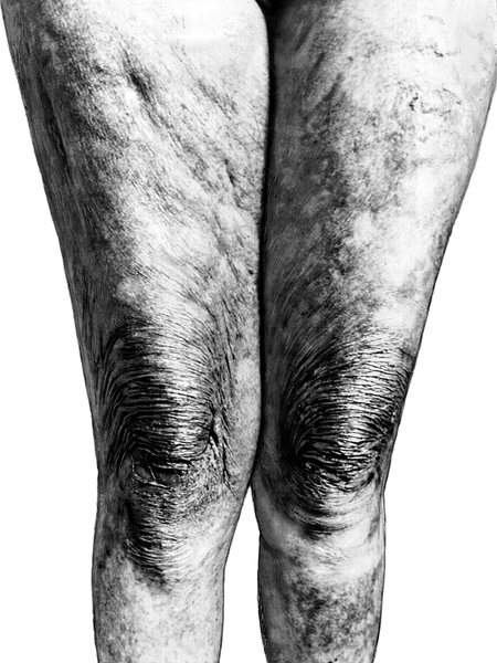 Рис. 1. Атрофический хронический акродерматит: истончение кожи нижних конечностей с выраженной складчатостью в области коленных суставов (<a href=