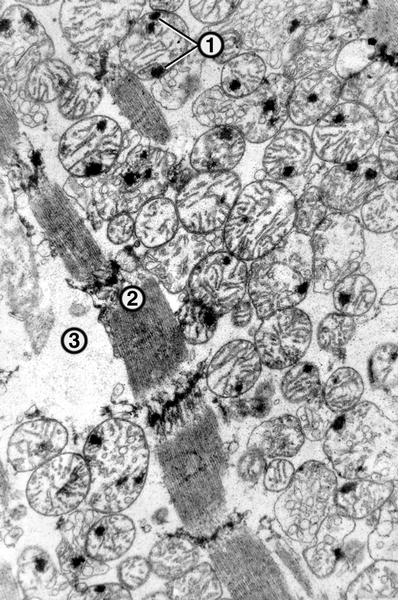 Рис. 4. Электронограмма кардиомиоцита (×12 000) с необратимыми повреждениями органелл в зоне ишемии: 1 — электронно-плотные включения кальция в митохондриях с разрушенными кристами; 2 — лизис миофибрилл; 3 — отек цитоплазмы, отсутствие гликогена