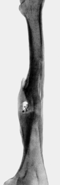 Рис. 3. Рентгенограмма бедренной кости больного с хроническим огнестрельным остеомиелитом: избыточная костная мозоль с дефектом костной ткани в центре