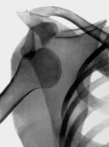 Рис. 5. Рентгенограмма правого плечевого сустава (прямая проекция) при передненижнем вывихе плеча с переломом большого бугорка плечевой кости