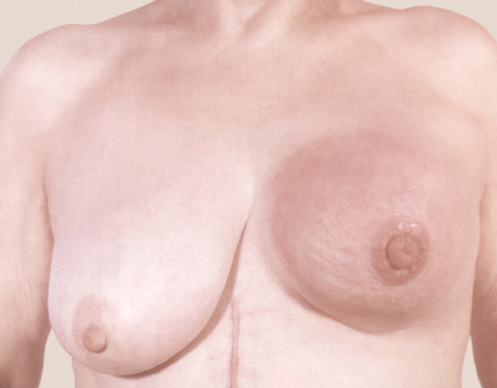 Рис. 6. Маститоподобная форма рака левой молочной железы