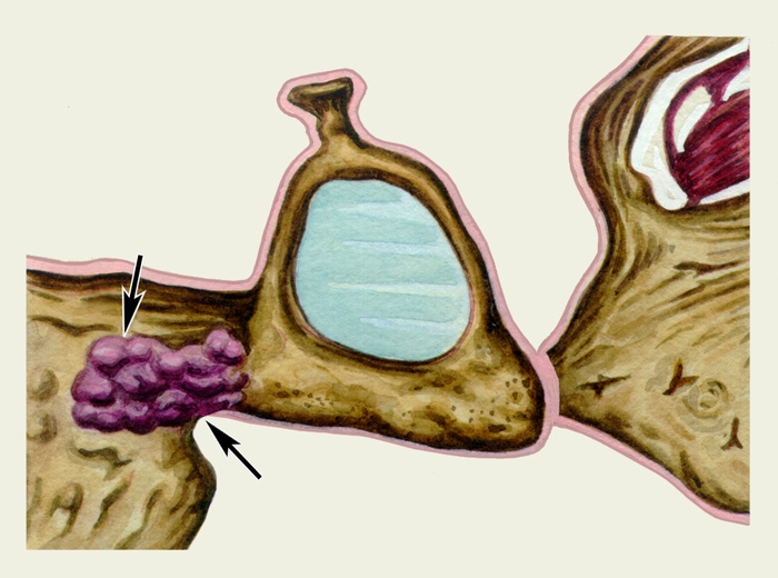 Рис. 1. Схематическое изображение стремени при отосклерозе (стрелками указан отосклеротический очаг на основании стремени)