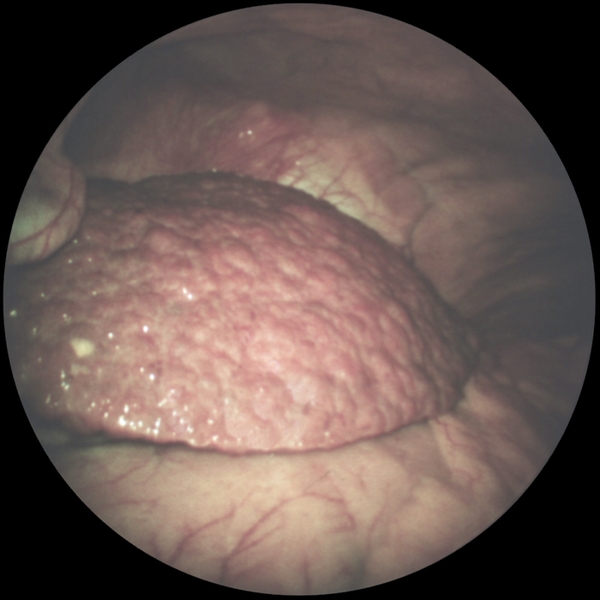 Рис. 2а). Лапароскопическая картина при некоторых заболеваниях и патологических состояниях органов брюшной полости — крупноузловой <a href=