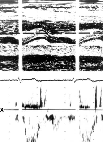 Рис. 9а). М-эхокардиограммы (вверху) и допплер-эхокардиограммы в форме спектрограмм (внизу) потока крови на уровне аортального клапана: в норме; отраженные сигналы от потока крови через аорту (указаны на спектрограмме стрелкой) возникают в систолу (следуют за желудочковым комплексом ЭКГ), направлены от изолинии х вниз (направление потока от датчика), имеют четкую очерченность и светлое «окно» в середине, что свидетельствует о ламинарном (нормальном) потоке