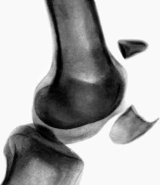 Рис. 21б). Рентгенограмма коленного сустава при поперечном переломе надколенника с расхождением отломков: боковая проекция