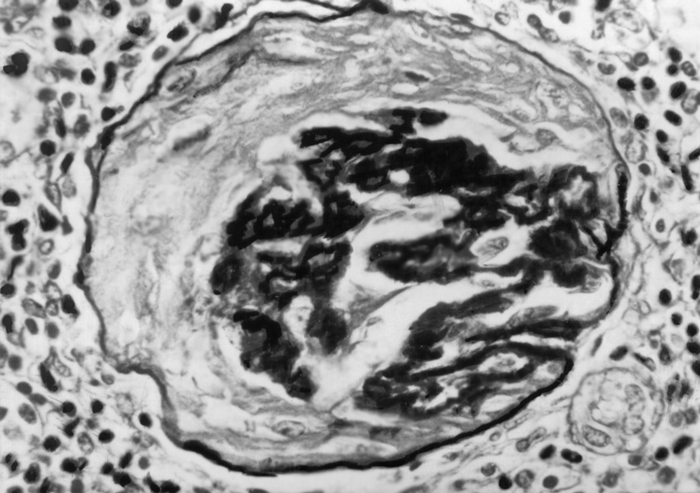 Рис. 1. Микропрепарат почки при доброкачественной форме нефросклероза: склероз и гиалиноз почечного клубочка; ШИК-реакция; ×750