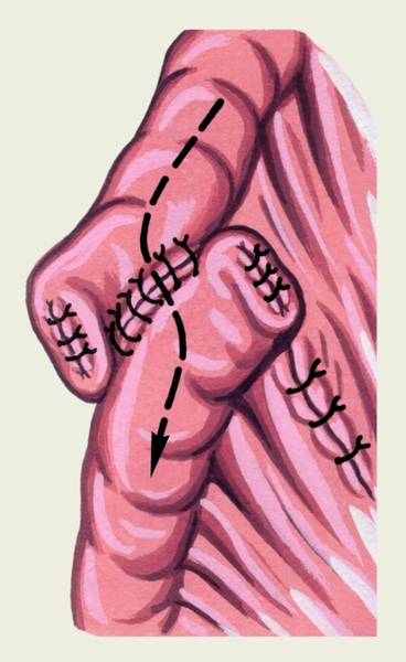 Рис. 7г). Схематическое изображение различных видов кишечного анастомоза: анастомоз бок в бок; стрелкой показано направление продвижения кишечного содержимого