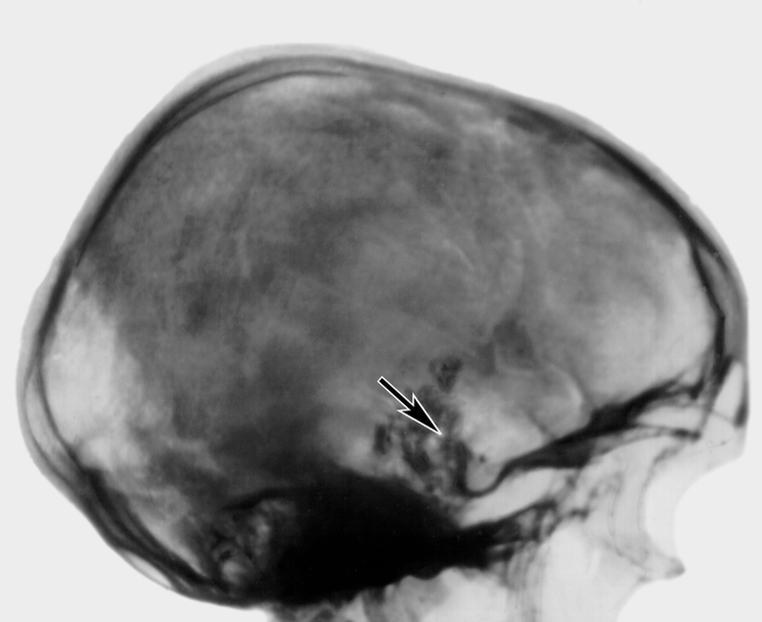 Рис. 13. Боковая рентгенограмма черепа больного с хордомой основания черепа без признаков гипертензии: обширный коралловидный <a href=
