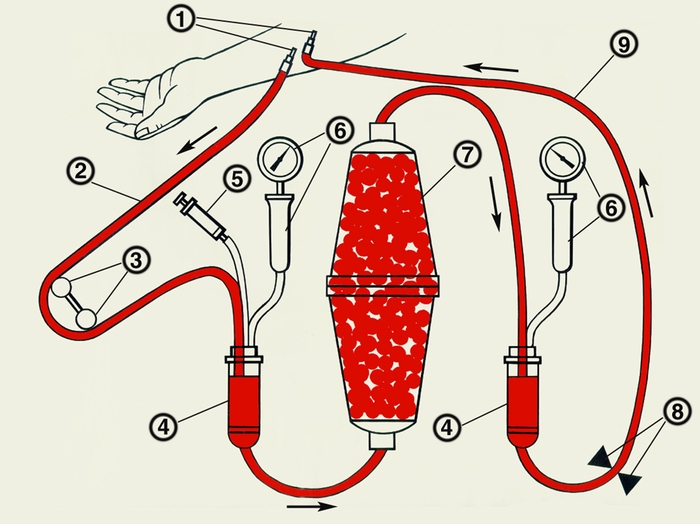 Принципиальная схема подключения устройства для проведения гемосорбции: 1 — катетеры, введенные в сосуды (в вену или в вену и артерию); 2 — трубчатая магистраль для забора крови; 3 — насос для прокачивания крови; 4 — пузырьковые камеры; 5 — устройство для подачи гепарина; 6 — манометры с делительными камерами, отделяющими их от непосредственного контакта с кровью; 7 — колонка с сорбентом; 8 — магнитный <a href=