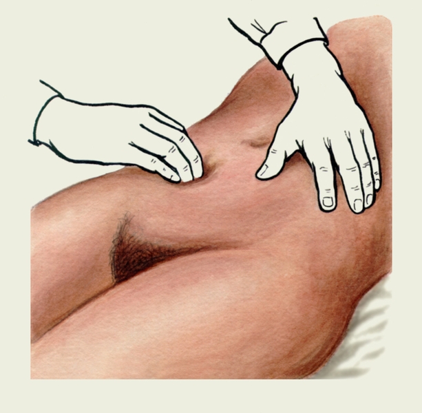 Рис. 5е). Положение рук исследующего при поверхностной ориентировочной пальпации слепой кишки