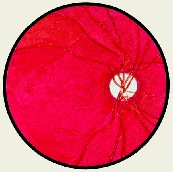 Нейропатия глаза. Атрофия зрительного нерва глазное дно. Нисходящая атрофия зрительного нерва. Атрофия диска зрительного нерва.