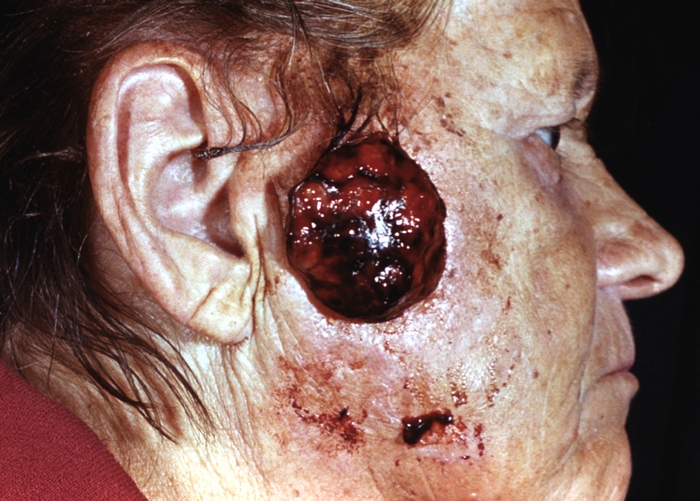 Рис. 9. Пиогенная гранулема: округлая темно-красного цвета четко ограниченная опухоль, выступающая над поверхностью кожи