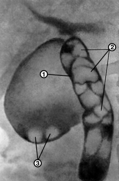 Рис. 2. Холеграмма при желчнокаменной болезни: 1 — резко расширенный общий желчный проток; 2 — многочисленные крупные желчные камни в общем желчном протоке; 3 — камни в области дна желчного пузыря