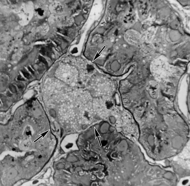 Рис. 4. Микропрепарат почки (полутонкий срез) при нефротическом синдроме: характерные пенистые клетки (указаны стрелками). <a href=