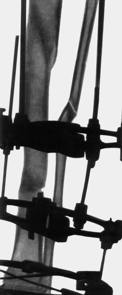 Рис. 24б). Рентгенограмма голени больного с хроническим посттравматическим остеомиелитом: компрессия с помощью аппарата Илизарова отломков большеберцовой кости, видны костные мозоли