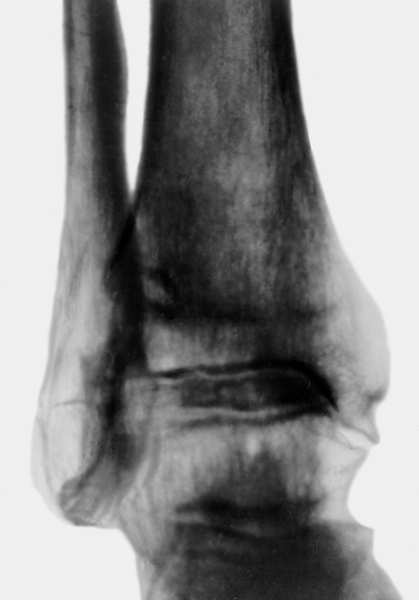 Рис. 2а). Рентгенограмма голеностопного сустава при постартрическом остеоартрозе: сужение суставной щели и краевые костные разрастания (прямая проекция)