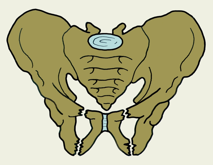 Рис. 6. Схематическое изображение двустороннего перелома лонной и седалищной костей