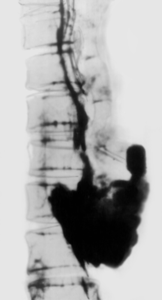 Рис. 3. Рентгенограмма пищевода при перфорации: принятое через рот рентгеноконтрастное вещество распространяется в заднем средостении в виде большого затека