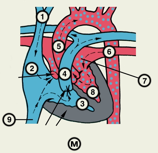 Рис. 23м). Схематическое изображение отдельных врожденных пороков сердца (направления кровотока обозначены пунктирными стрелками, <a href=