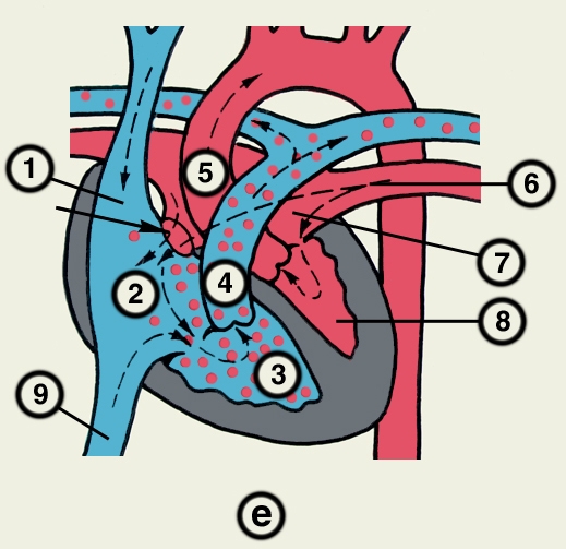 Рис. 23е). Схематическое изображение отдельных врожденных пороков сердца (направления кровотока обозначены пунктирными стрелками, локализация пороков — сплошными стрелками): дефект межпредсердной перегородки; 1 — верхняя полая вена, 2 — правое предсердие, 3 — правый желудочек, 4 — легочный ствол, 5 — аорта, 6 — легочная вена, 7 — левое предсердие, 8 — левый желудочек, 9 — нижняя полая вена
