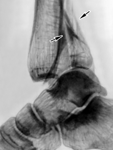 Рис. б). Рентгенограмма правого голеностопного сустава в боковой проекции при переломе Потта: переломы заднего края большеберцовой кости и наружной лодыжки (указаны стрелками), задний подвывих стопы