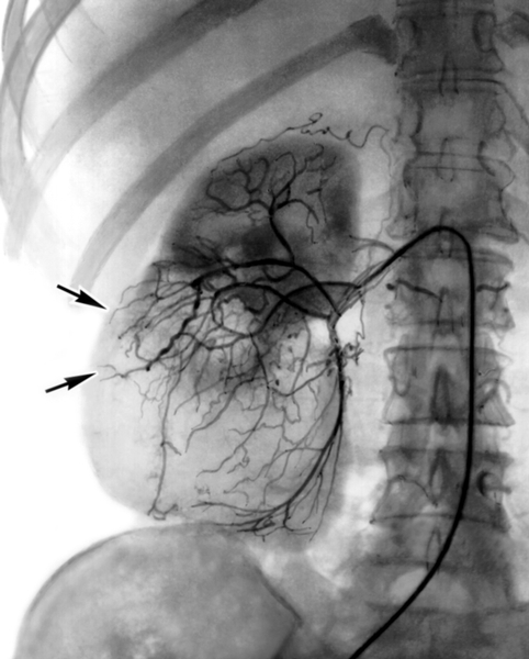 Рис. 7. Селективная почечная артериограмма при опухоли правой почки: в области нижнего полюса и среднего сегмента почки видны новообразованные сосуды; стрелками указаны так называемые лужицы