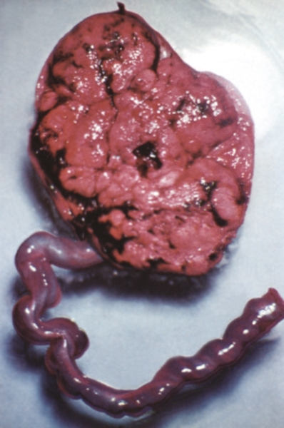 Рис. 6а). Плацента при отечной форме гемолитической болезни плода: на материнской поверхности плаценты отмечаются отек, кровоизлияния