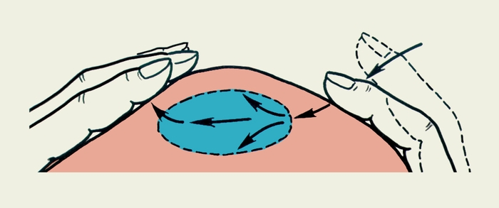 Схематическое изображение определения флюктуации: пальцами одной руки выполняют короткие толчки в исследуемой области, ощущая при этом пальцами другой руки зыбление в виде волны