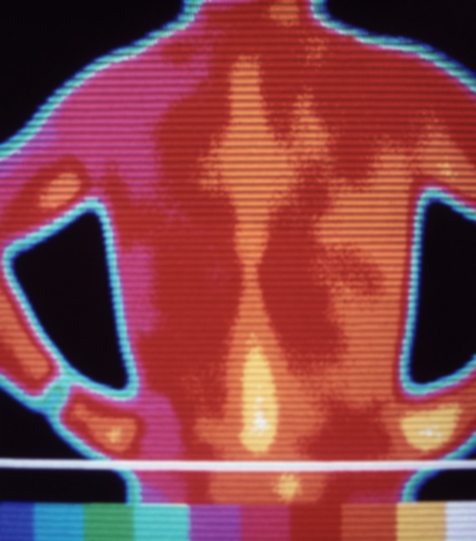 Рис. 15. Термограмма задней поверхности грудной клетки при крупозной правосторонней пневмонии: в правом легком определяются сливные очаги гипертермии (желтого цвета)