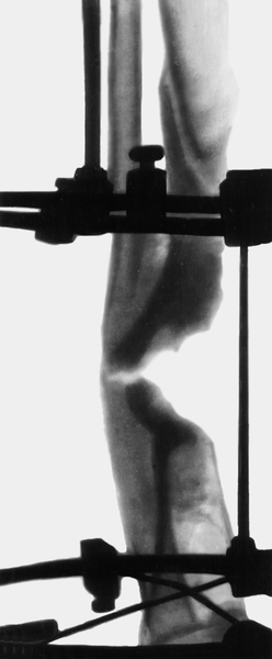 Рис. 21б). Рентгенограмма голени больного с хроническим посттравматическим остеомиелитом: наложен дистракционно-компрессионный <a href=
