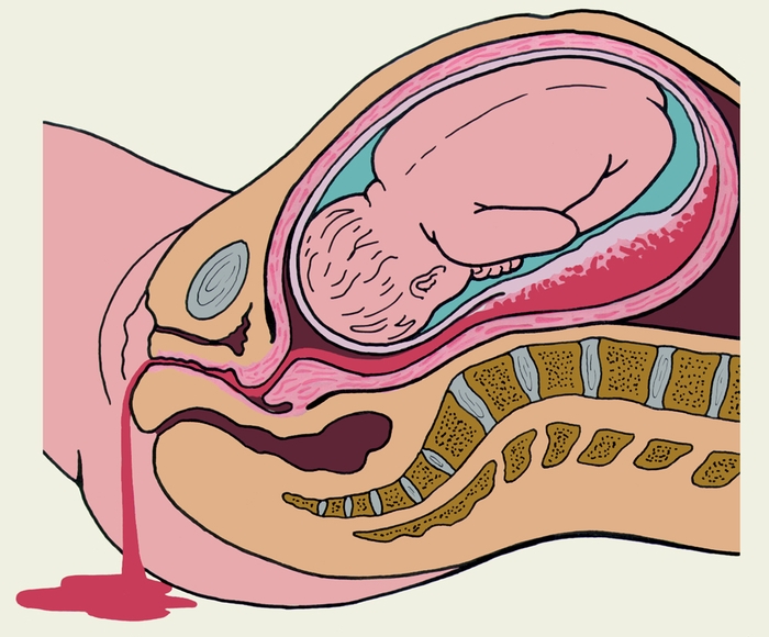 Рис. 3. Ретроплацентарная гематома и наружное кровотечение при отслойке нормально расположенной плаценты в центральной и краевой ее частях