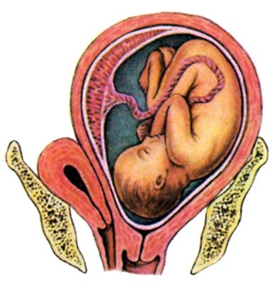 Рис. 5а). Схематическое изображение плода в матке при удвоении матки и влагалища