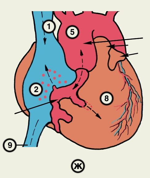 Рис. 23ж). Схематическое изображение отдельных врожденных пороков сердца (направления кровотока обозначены пунктирными стрелками, локализация пороков — сплошными стрелками): коронарно-сердечный свищ — аневризматическое расширение венечной (правой) артерии (вследствие заброса крови из полости сердца); 1 — верхняя полая вена, 2 — правое предсердие, 5 — аорта, 8 — левый желудочек, 9 — нижняя полая вена